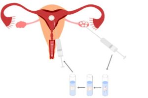 微刺激促排卵方案能否持续用于试管婴儿取卵?需注意的风险有哪些