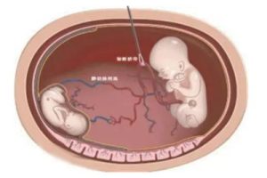 微刺激方案:选择合适的移植时机能够提升成功率