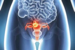 试管婴儿促排卵长期方案