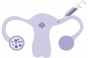 高龄女性卵泡数量少该如何处理?还有怀孕的机会吗?