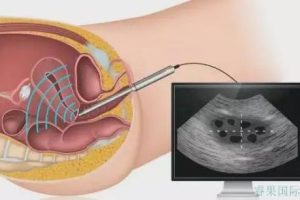 高龄女性辅助生殖指引:选择合适的技术与科学准备,提高怀孕成功