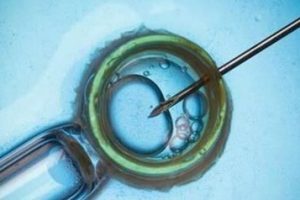 辅助生殖取卵全面指南:卵泡标准、费用详解、疼痛比较及并发症预